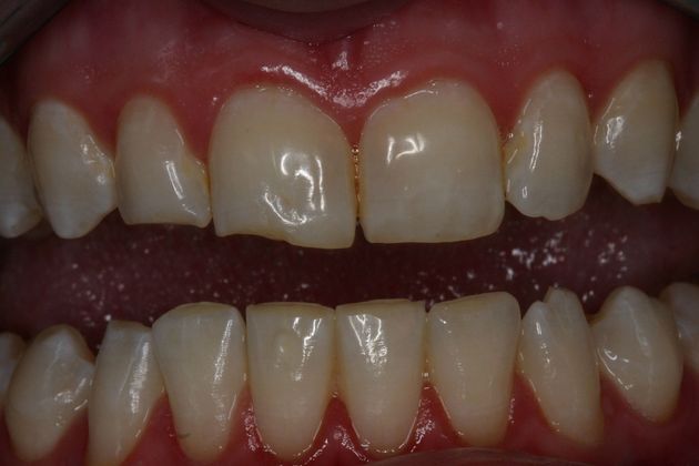 Cosmetic Bonding: Case 5 - Before