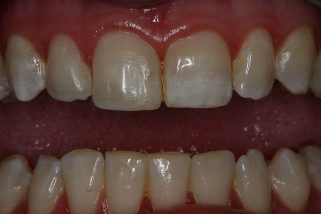Cosmetic Bonding: Case 5 - After