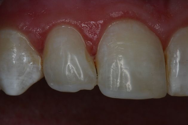 Cosmetic Bonding: Case 5 - After