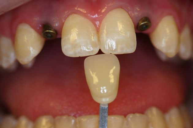 Implant Restorations: Case 1 - Before