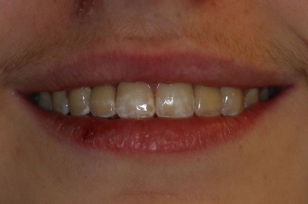 Implant Restorations: Case 1 - After