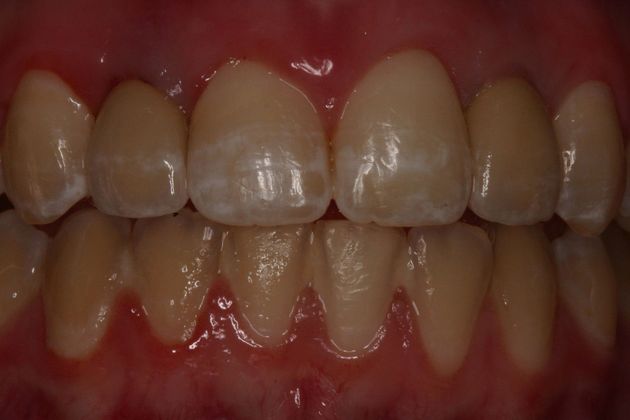 Implant Restorations: Case 1 - After
