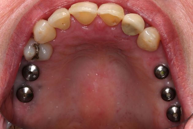 Implant Restorations: Case 2 - Before
