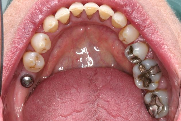 Implant Restorations: Case 2 - Before