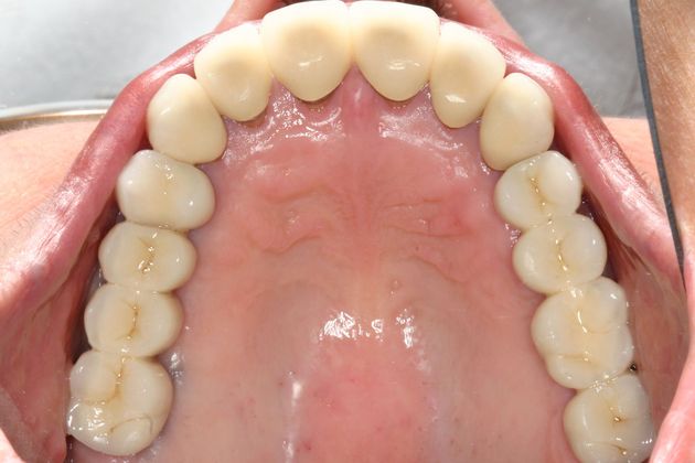Implant Restorations: Case 2 - After