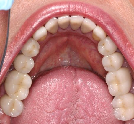 Implant Restorations: Case 2 - After