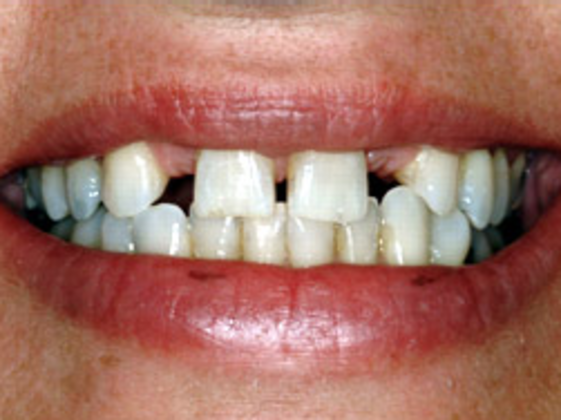 Smile Makeover Album: Case 1 - Before