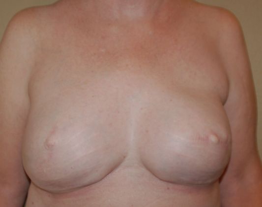 Breast Reconstruction Case 34 - After