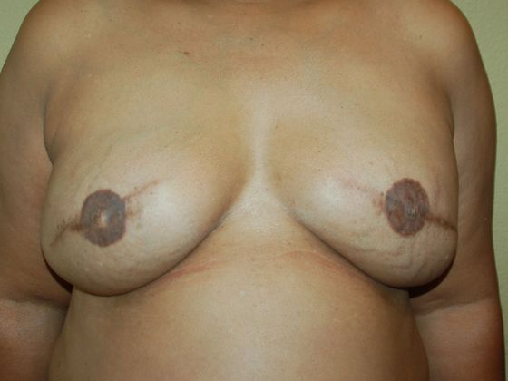 Breast Reconstruction Case 36 - After