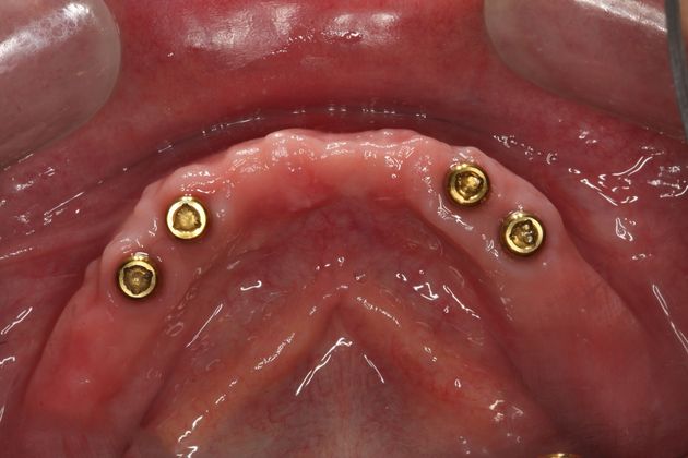 Dentures Case 1 - Edmonton, AB - Before
