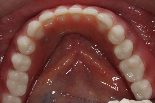 Dentures Case 1 - Edmonton, AB - After