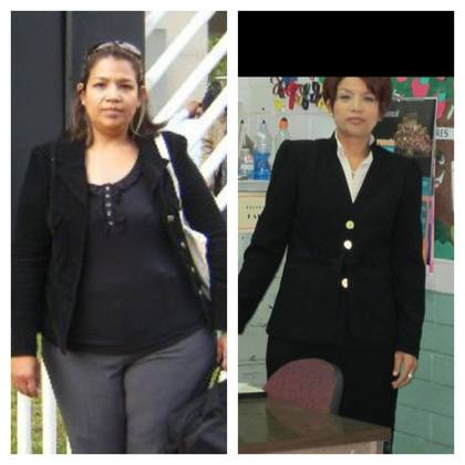 gastric bypass before and after black women