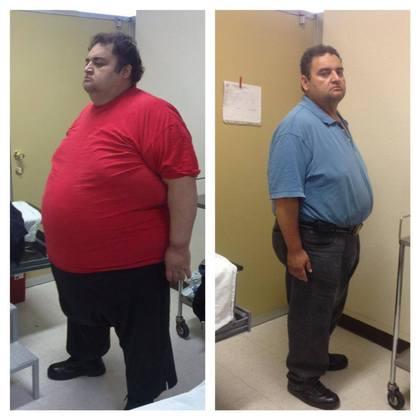 Tijuana Gastric Sleeve Surgery Before and After Photos: Patient