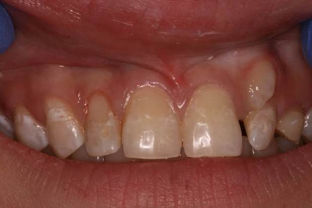 Decay on upper front teeth - Tooth Colored Bonding - Before and After ...