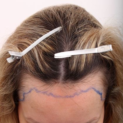 Hair Transplant - Female: Hairline FUT (13) - Before female hair transplant