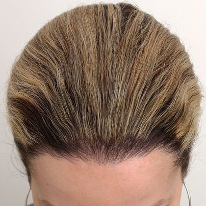 Hair Transplant - Female: Hairline FUT (13) - After female hair transplant