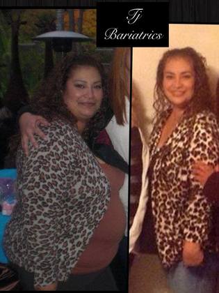 Gastric Sleeve - Click Here to See More! : Case 15* - Before and After