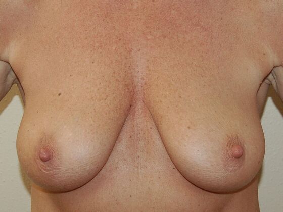 Breast Augmentation w/ Lift Case 1 - Before