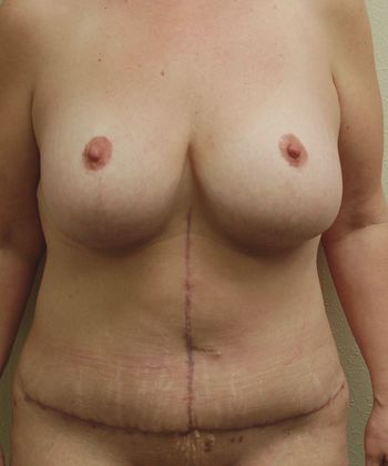 Massive Weight Loss : Case 16 - After