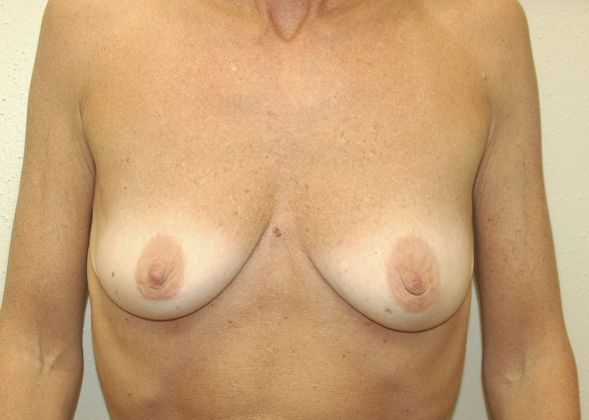 Breast Reconstruction Case 38 - Before