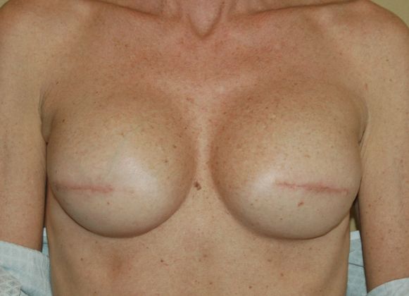 Breast Reconstruction Case 38 - After