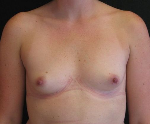 Breast Augmentation Case 14 - Before