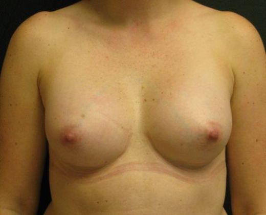 Breast Augmentation Case 14 - After