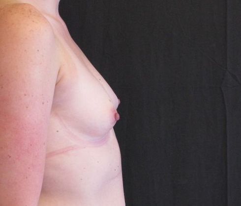 Breast Augmentation: Case 14 - before