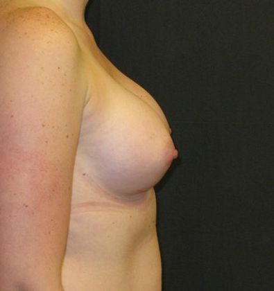 Breast Augmentation: Case 14 - after 