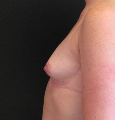 Breast Augmentation: Case 14 - before