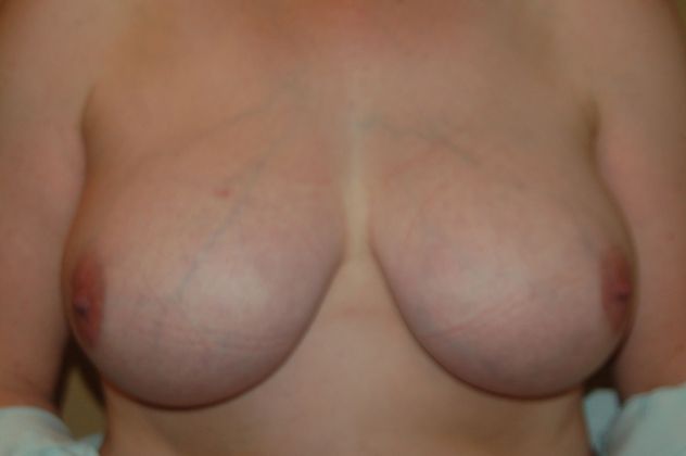 Breast Reduction Case 10 - Before