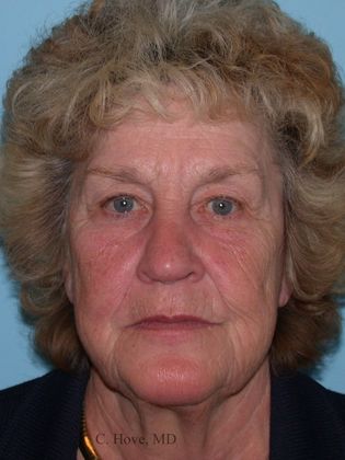 Facelift (Rhytidectomy) Case 1-  Facelift, Necklift and Laser peel (Dr Christopher Hove, Philadelphia