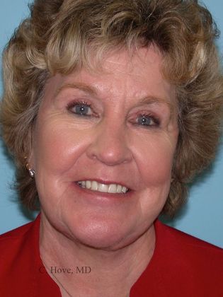 Facelift (Rhytidectomy) Case 1-  Facelift, Necklift and Laser peel (Dr Christopher Hove, Philadelphia