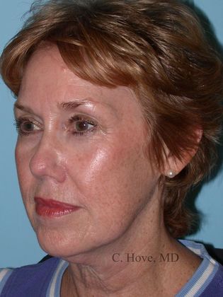 Facelift (Rhytidectomy) Case 6-  Facelift & Necklift (Dr Christopher Hove, Philadelphia
