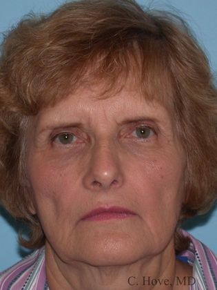 Facelift (Rhytidectomy) Case 7-  Facelift & Necklift (Dr Christopher Hove, Philadelphia