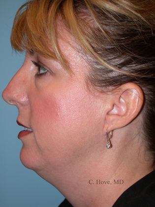 Facelift (Rhytidectomy) Case 9- Neck lift (Dr Christopher Hove, Philadelphia