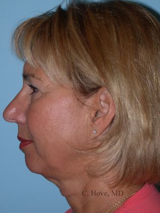 Facelift (Rhytidectomy) Case 10- Neck lift (Dr Christopher Hove, Philadelphia