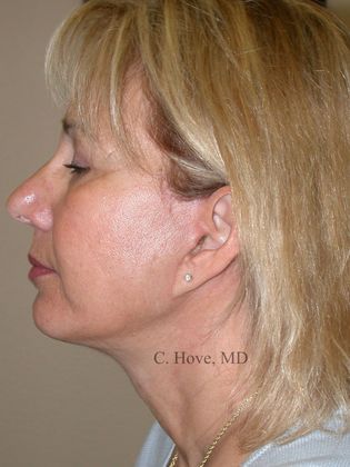 Facelift (Rhytidectomy) Case 10- Neck lift (Dr Christopher Hove, Philadelphia
