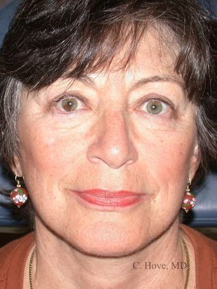 Facelift (Rhytidectomy) Case 11- Facelift & Necklift (Dr Christopher Hove, Philadelphia