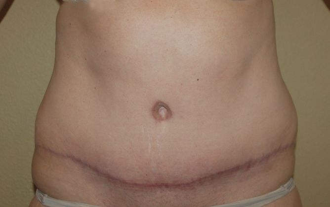 Tummy Tuck (Abdominoplasty) Case 39 - After