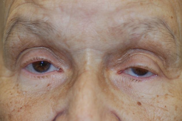 Case 4 - Ptosis Repair - Before and After Gallery