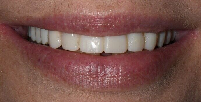 Malformed Smile & Missing Teeth Cases