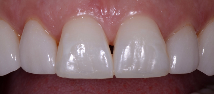 Porcelain Crowns Porcelain Crowns to lengthen and correct chipped upper teeth - After