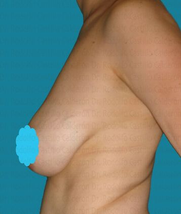 Breast Lift Breast Lift With Implants - Before