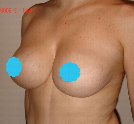 Breast Lift: Breast Lift With Implants - After her breast lift oblique view