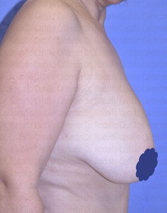 Breast Lift: Breast Lift With no Volume increase - Breast lift before lateral