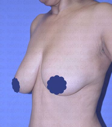 Breast Lift: Breast Lift With no Volume increase - Breast lift before oblique