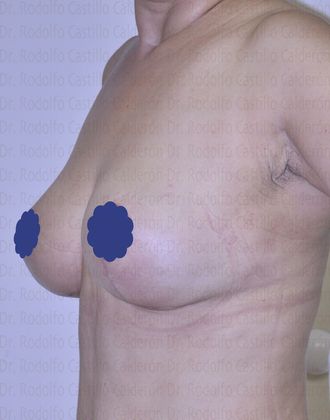 Breast Lift: Breast Lift With no Volume increase - Breast lift after