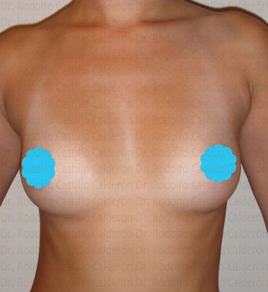 Breast Augmentation: Breast Augmentation - Before Breast Augmentation