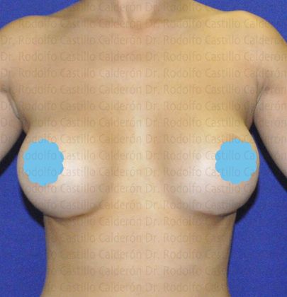 Breast Augmentation: Breast Augmentation - After Breast Augmentation